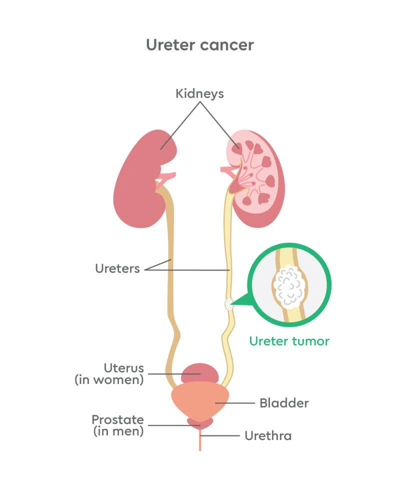 Diagram of ureter cancer