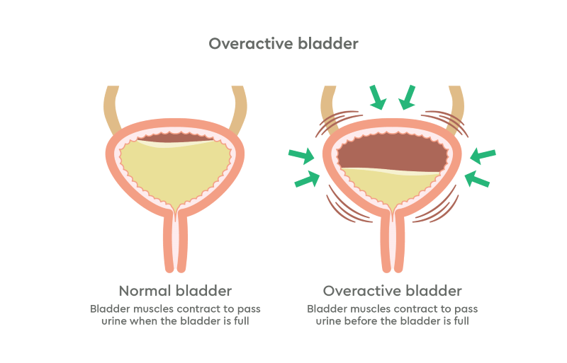 overactive bladder diagram