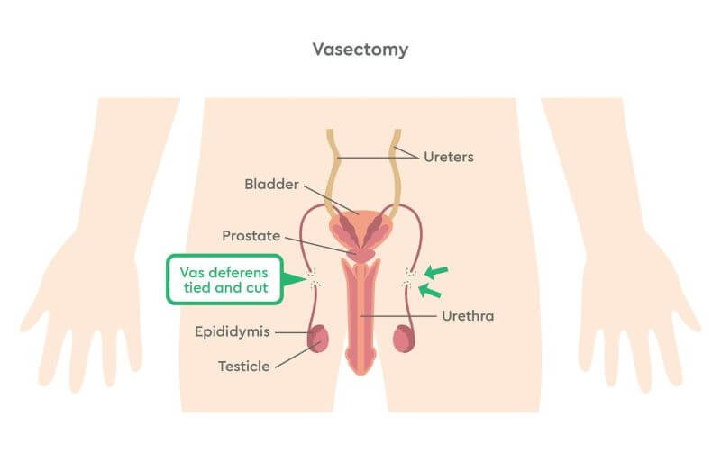 Vasectomy diagram