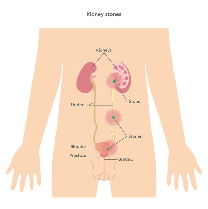 Diagram showing kidney stones in the urinary tract